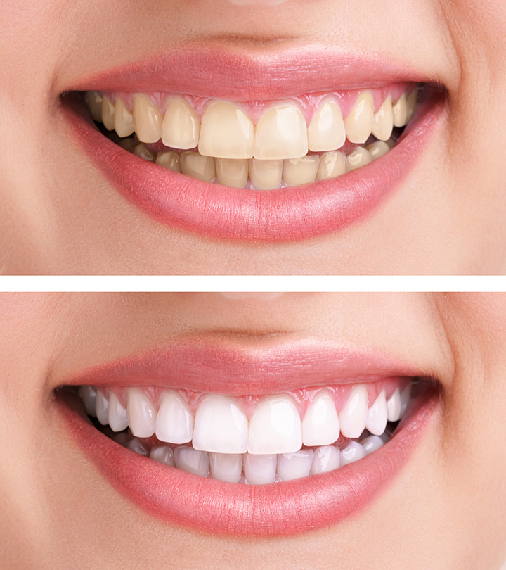 Augment licht lezer Tanden bleken - Dental Center